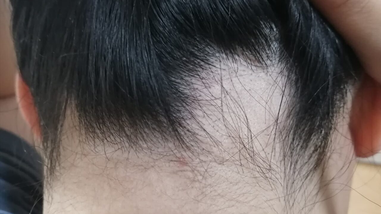 円形脱毛症とは何ですか?